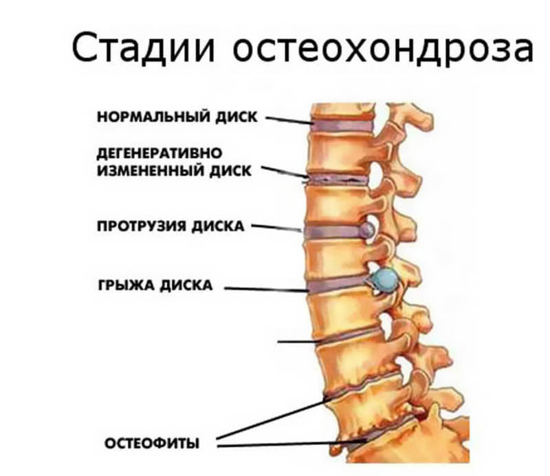 Остеохондроз - это не болезнь, это образ жизни! Выход есть! 