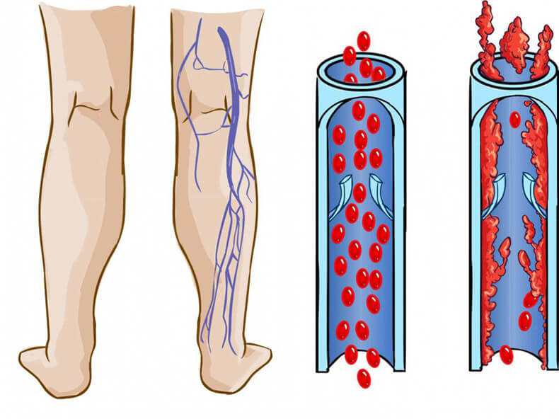 Варикоз Глубоких Вен Как Лечить